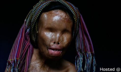 캄보디아 남편에게 산성 공격 당한 여성 (혐오주의) | 인스티즈