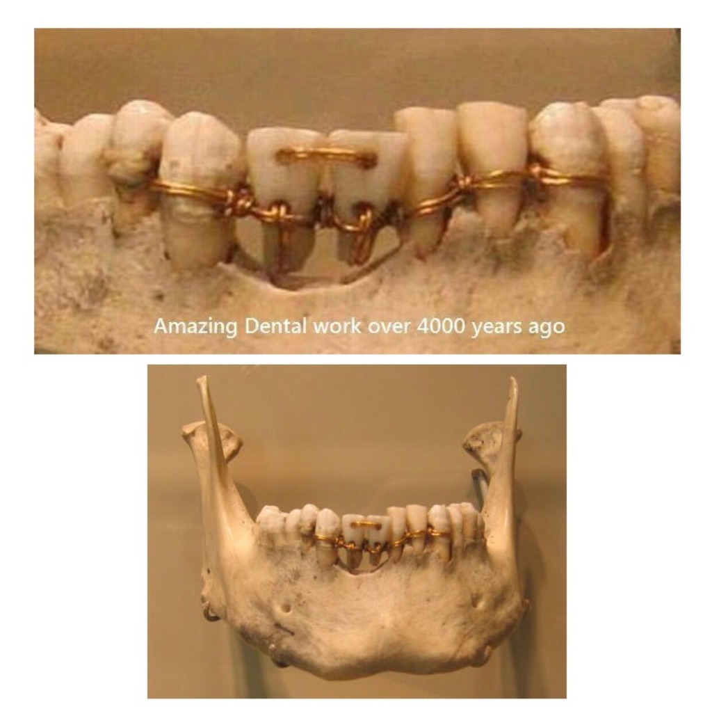 4000년전 치아교정 | 인스티즈