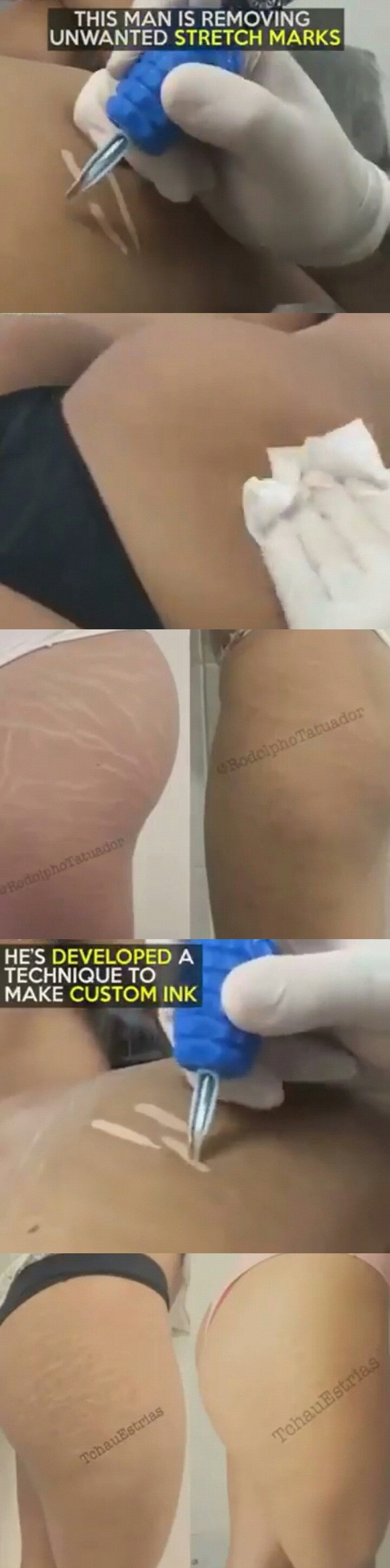 우리나라에서도 조금씩 대중화되가고 있는 시술 jpg | 인스티즈