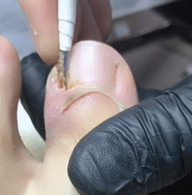 쾌감 오지는 내성발톱 제거 움짤ㄷㄷㄷㄷㄷㄷ. gif (혐오주의) | 인스티즈